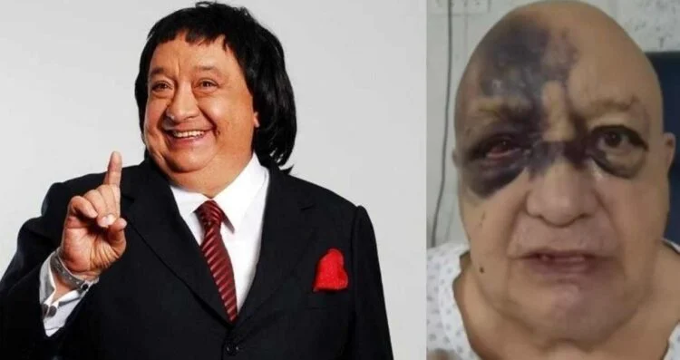 Luis de Alba preocupa a sus seguidores tras aparecer con moretones en el rostro